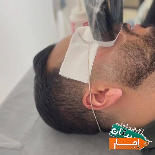 خدمات اجاره دستگاه لیزر موهای زائد پلاتینیوم پلاس